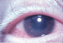 eye with uveitis