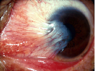 pterygium