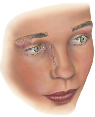 Human Eye Irrigation system. Shown are the lacrimal gland, lacrimal duct, lacrimal puncta, lacrimal canaliculus, nasolacrimal duct, cornes, pupil and iris